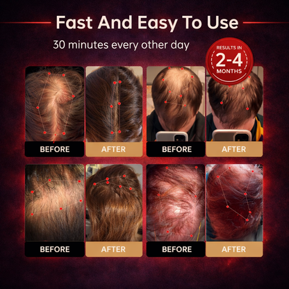 🔥Last Day:63% off 🔥 Red Light Therapy Regrowth Cap
